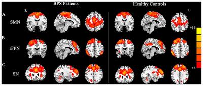Multiple Neural Networks Malfunction in Primary Blepharospasm: An Independent Components Analysis